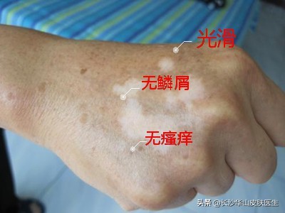 白癜风早期症状为什么会得白癜风,白癜风早期表现和白癜风发病部位