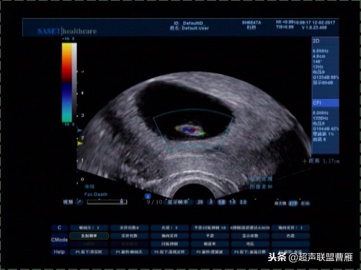 3毫米卵黄囊未见胎芽正常么,40多天的卵黄囊