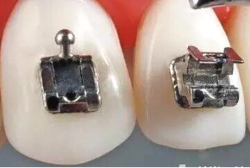 戴牙套戴哪种牙套最好,金属牙套与陶瓷牙套的优缺点