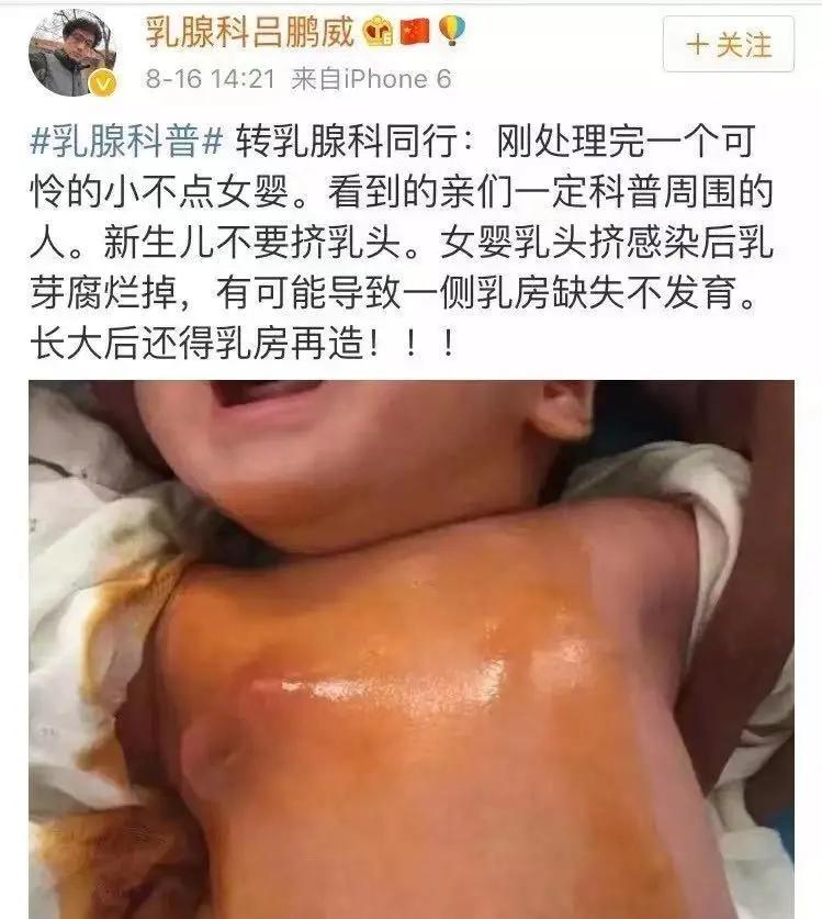 还在给新生儿挤乳头？这种糟糕习俗危害大到抱憾终身