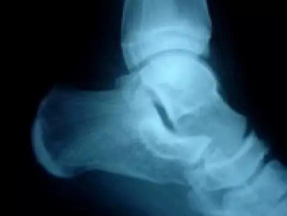 所有骨折都叫什么名字,骨折的名称有哪些