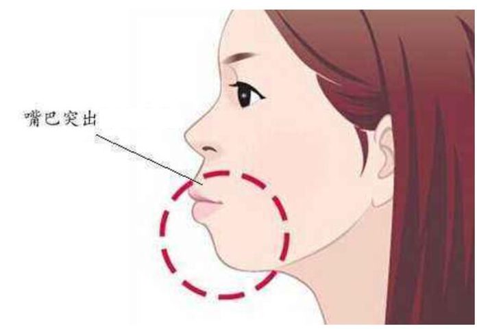“龅牙”是深覆颌还是深覆盖,两者如何区分?