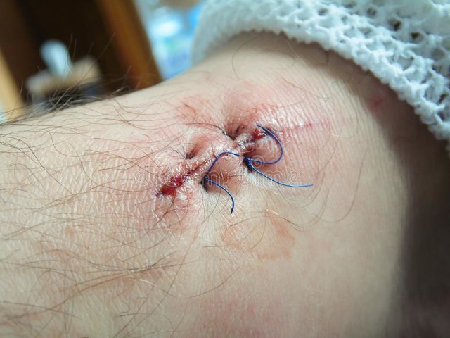 伤疤结痂怎么老不掉啊,伤疤结痂后为啥很长时间不愈合