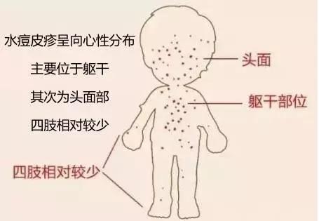 水痘高发期提醒信息,什么季节容易得水痘