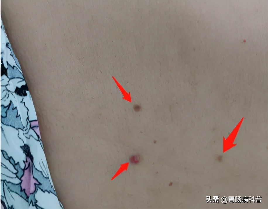 七十岁老太太腿部长了个肉疙瘩,70岁老太太患上了癌症