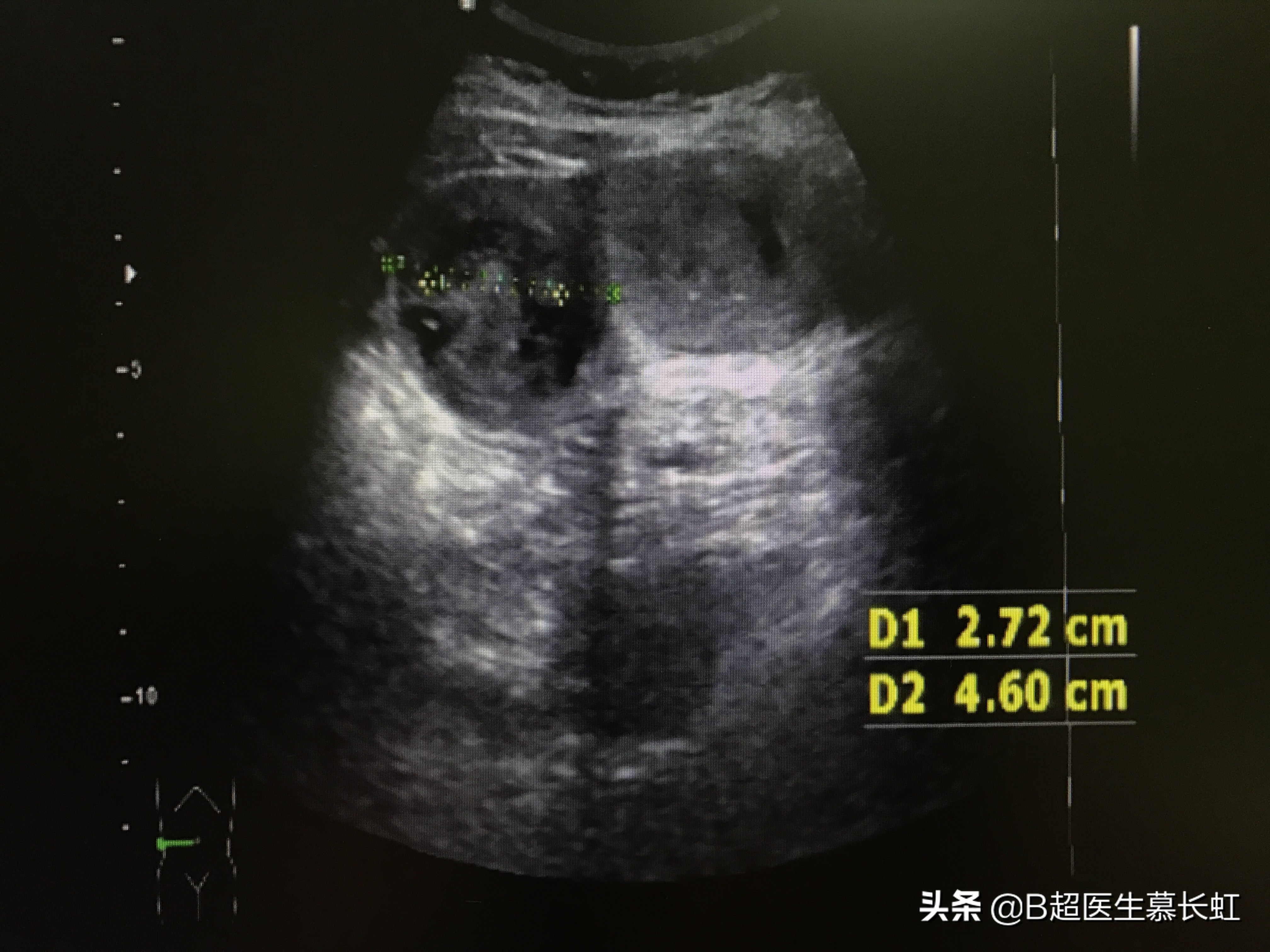 结石山楂可以吃吗,山楂容易长结石吗