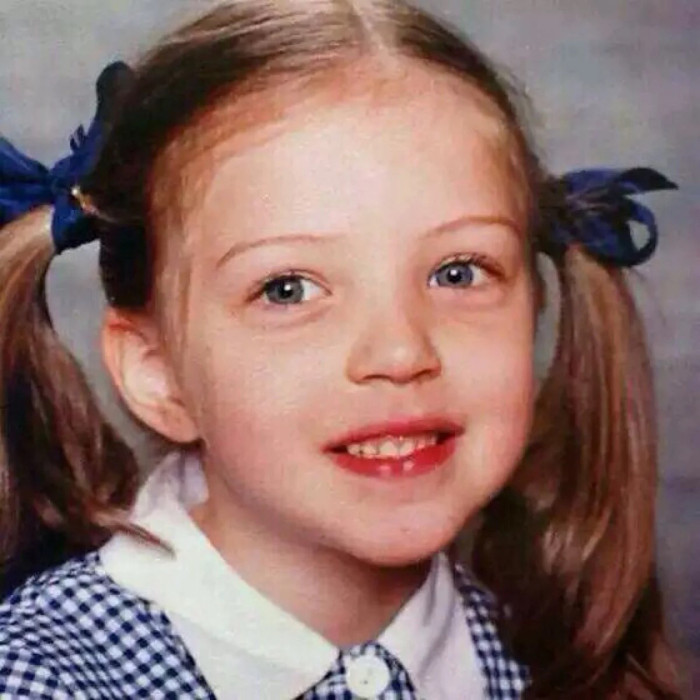 身上的红胎记,宝宝眼皮上有个红胎记