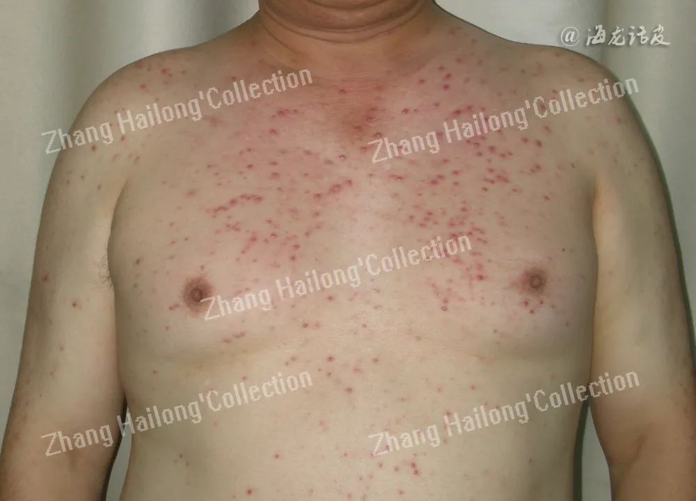 胸毛囊炎有红点,胸前长了很多马拉色菌毛囊炎