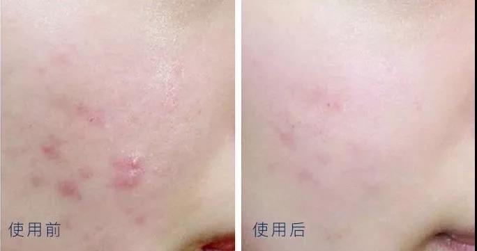 全网最好用的祛痘产品,祛痘产品最良心测评