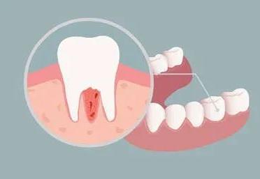 牙齿反复发炎,吃药也没用!该怎么治疗才好?