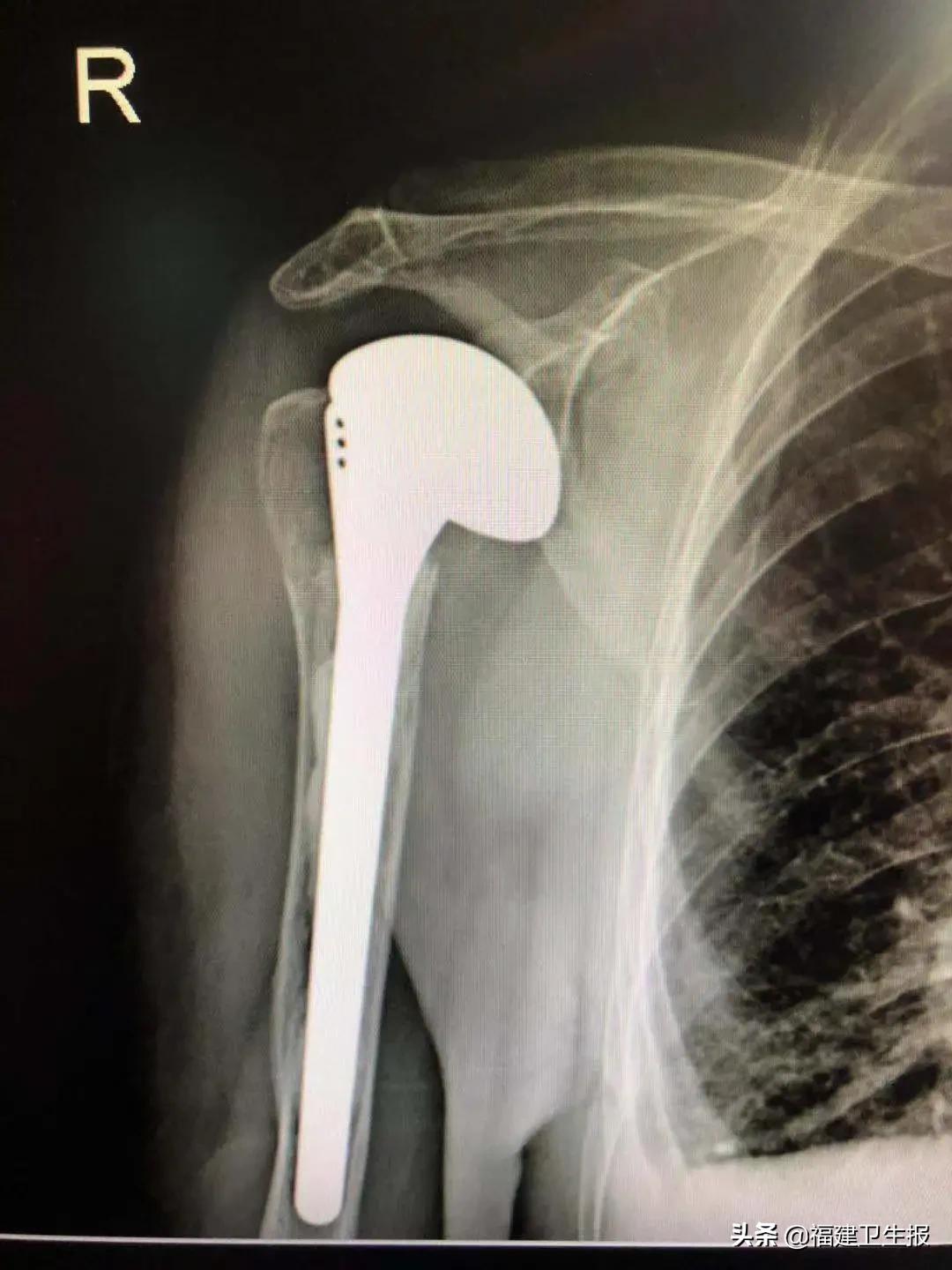 省内首例！福州95岁老奶奶滑倒后右肩骨折多次脱臼，医生成功为她“换肩”！