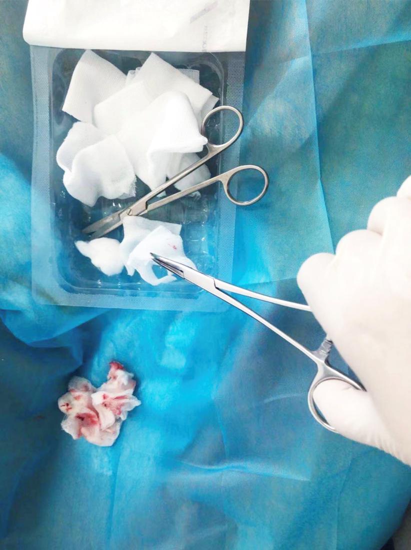 顽固压疮深达骨头，护士上门30余次终治愈