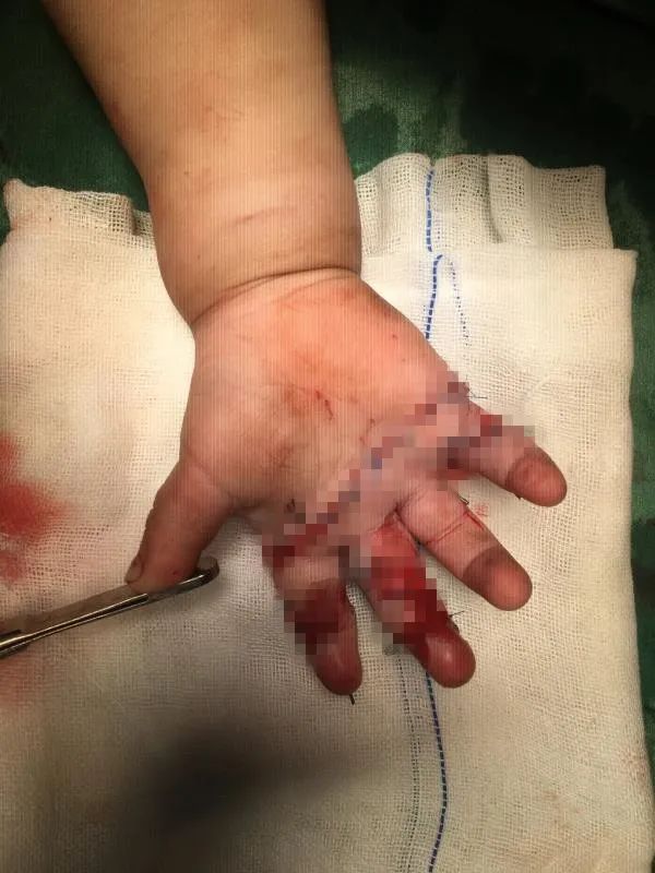 男子不慎断指医生妙手再造手指,男孩手被割伤险断指医生极力救治