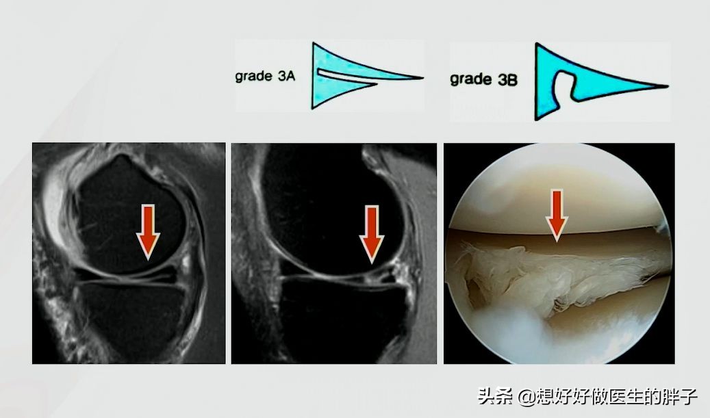 为什么足球运动员不会半月板受伤,半月板伤病对足球运动员影响大吗