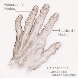 骨刺与骨性关节炎疼痛有什么区别,关节炎骨刺是怎么造成的