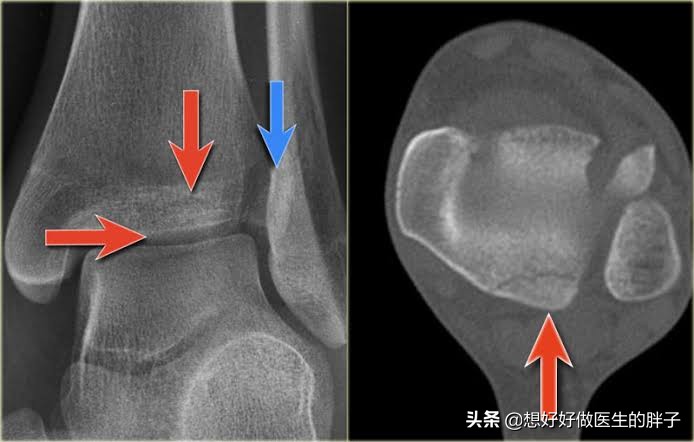 脚踝扭伤胫骨腓骨远端有点疼,腓骨受伤恢复