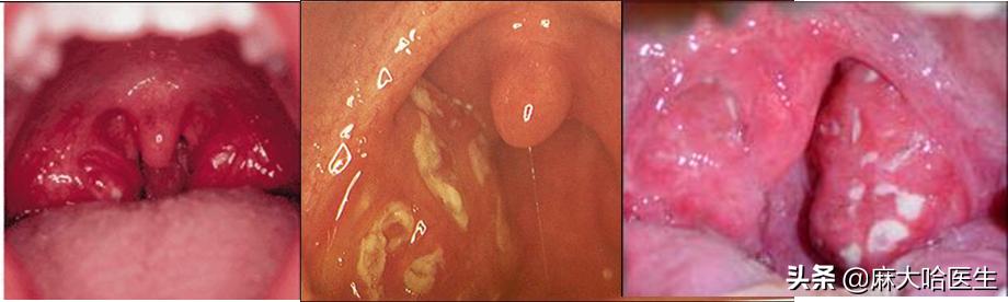 小孩扁桃体切除疼不疼,扁桃体切除术后疼不疼