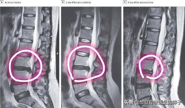 腰椎间盘突出核掉椎管里怎么治疗,腰椎间盘髓核掉进椎管严重吗