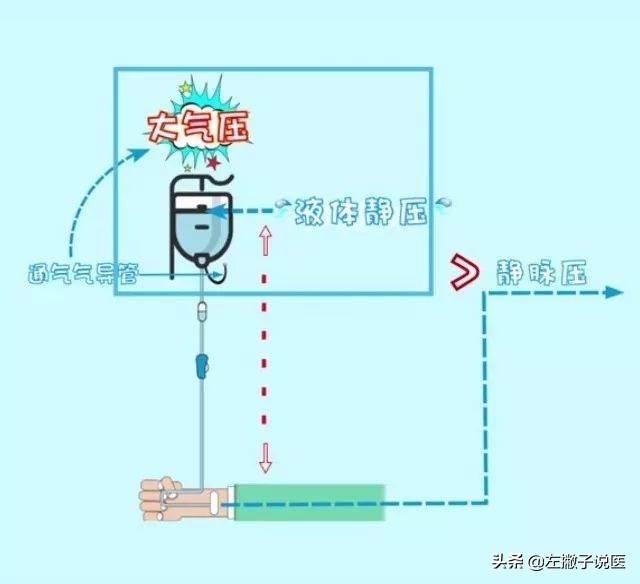 打吊针进了空气有后遗症,打吊针空气进入体内多久感觉不适