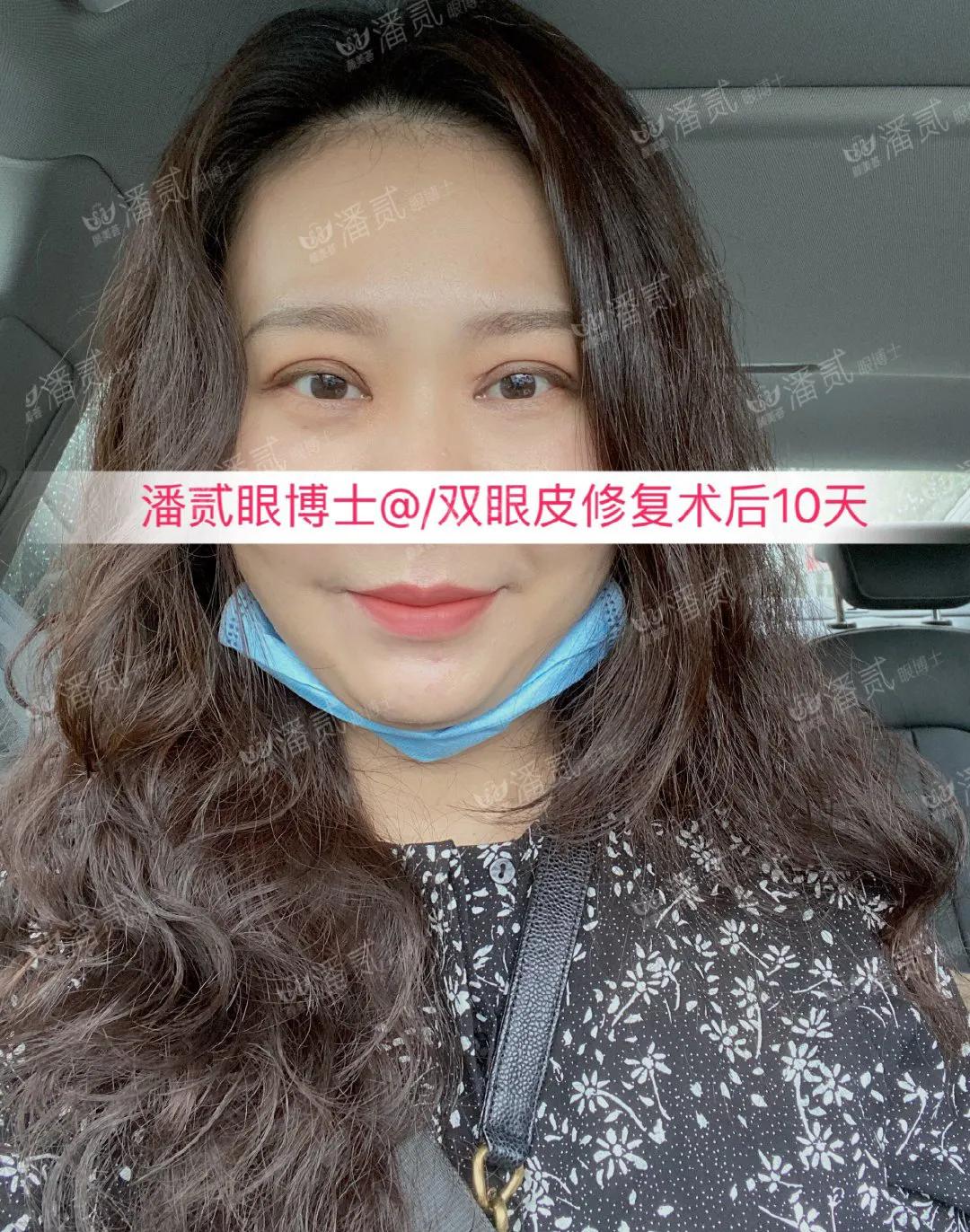 双眼皮修复改扇形双眼皮,平行双眼皮能改成开扇形双眼皮吗