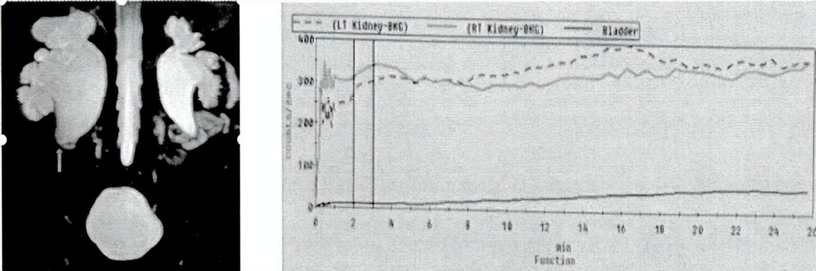 中医治疗宝宝肾积水输尿管狭窄,小儿肾积水和输尿管扩张怎么治疗