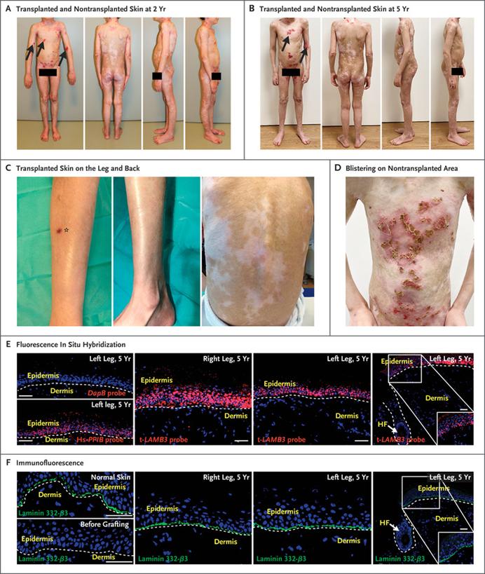 基因治疗带来的希望,基因疗法有望治愈的10种疾病