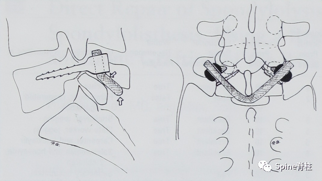 轻度峡部裂和重度峡部裂的区别,真性峡部裂和假性峡部裂
