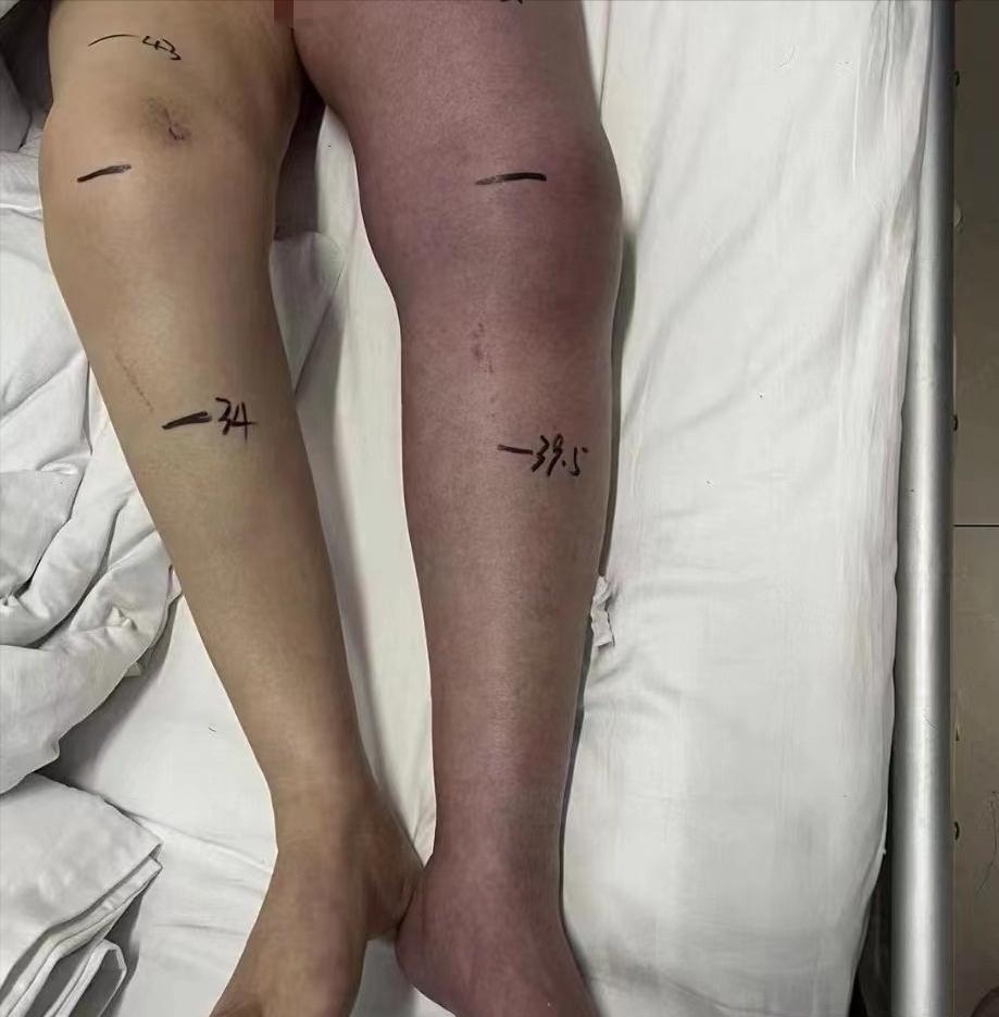 双下肢横纹肌肉溶解症,下肢肿胀鉴别诊断