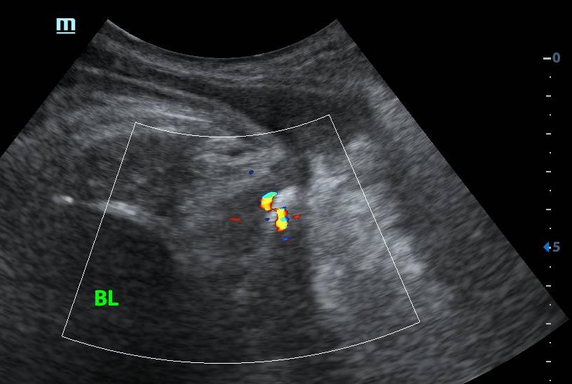 八十岁老爷爷小便尿不出来,85岁老人小便拉不出来是怎么回事