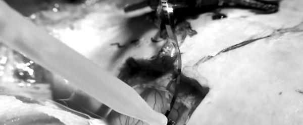 专家研究三十年蚊子,是谁发现蚊子发明了无痛针管