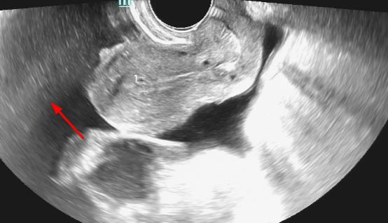 b超能查出盆腔肿瘤吗,B超能查出盆腔炎症吗