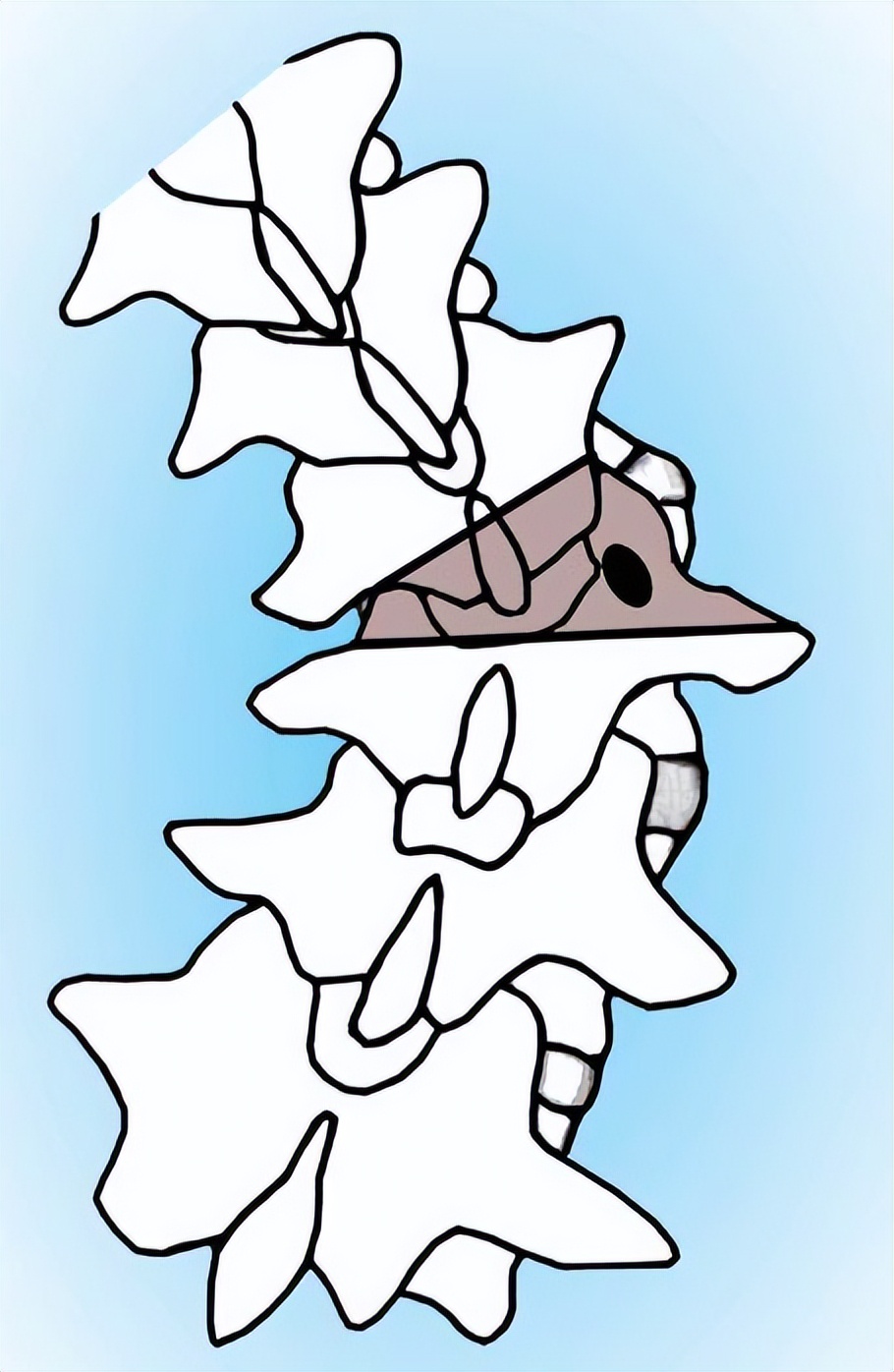 骨科基础：脊柱后侧凸截骨术