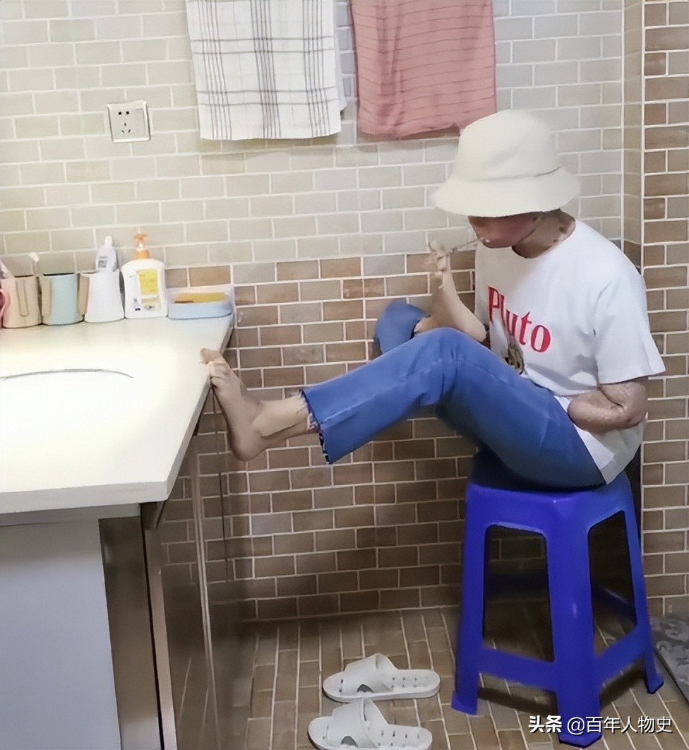 19年,四川20岁女孩遭大火毁容48%烧伤,双臂截肢如今怎么样了?