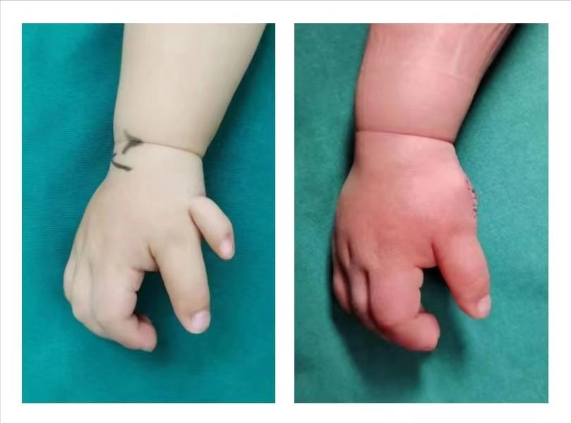 骨科医生手畸形,先天性手关节畸形弯曲