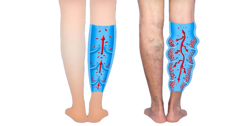 有静脉曲张的人可以每天泡脚吗,有静脉曲张的人能用热水泡脚吗