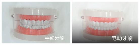 电动牙刷用法不正确有什么副作用,电动牙刷注意事项这三类人要慎用