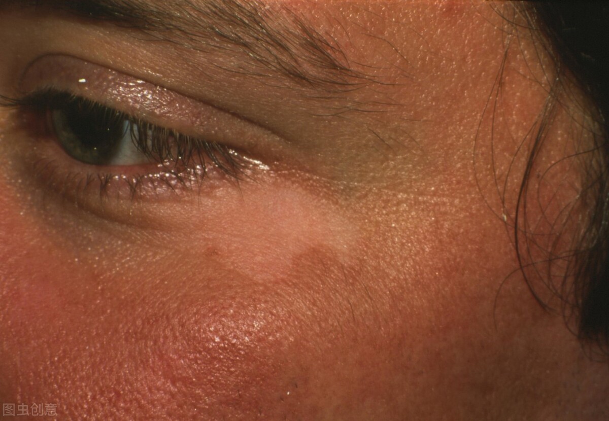 女朋友有白癜风我该怎么办,儿童得了白癜风能治好吗