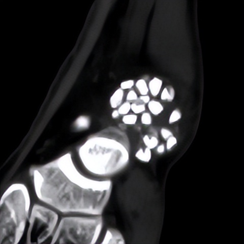 脚踝轻微扭伤如何处理,脚踝轻微扭伤用什么药物