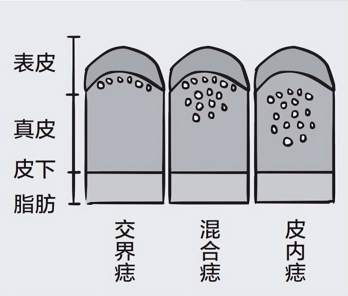 长在身体什么部位的痣容易癌变,脖子突然长痣是癌症的症状