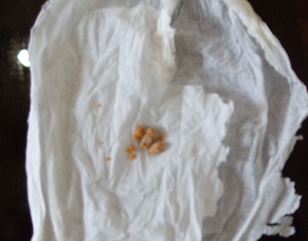 扁桃体为什么老是容易发炎,扁桃体为什么容易发炎