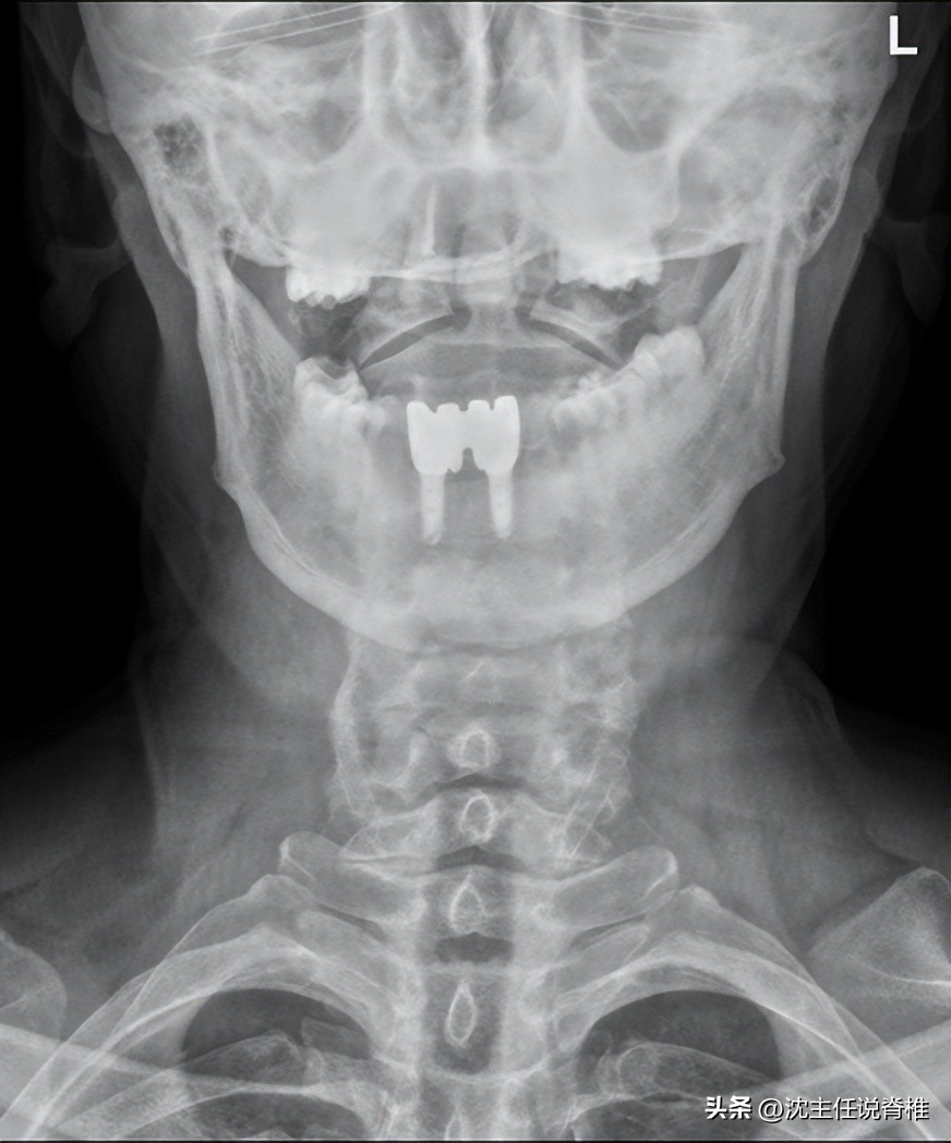耳朵嗡嗡响耳鸣头晕怎么回事,突然耳鸣是颈椎引起的吗