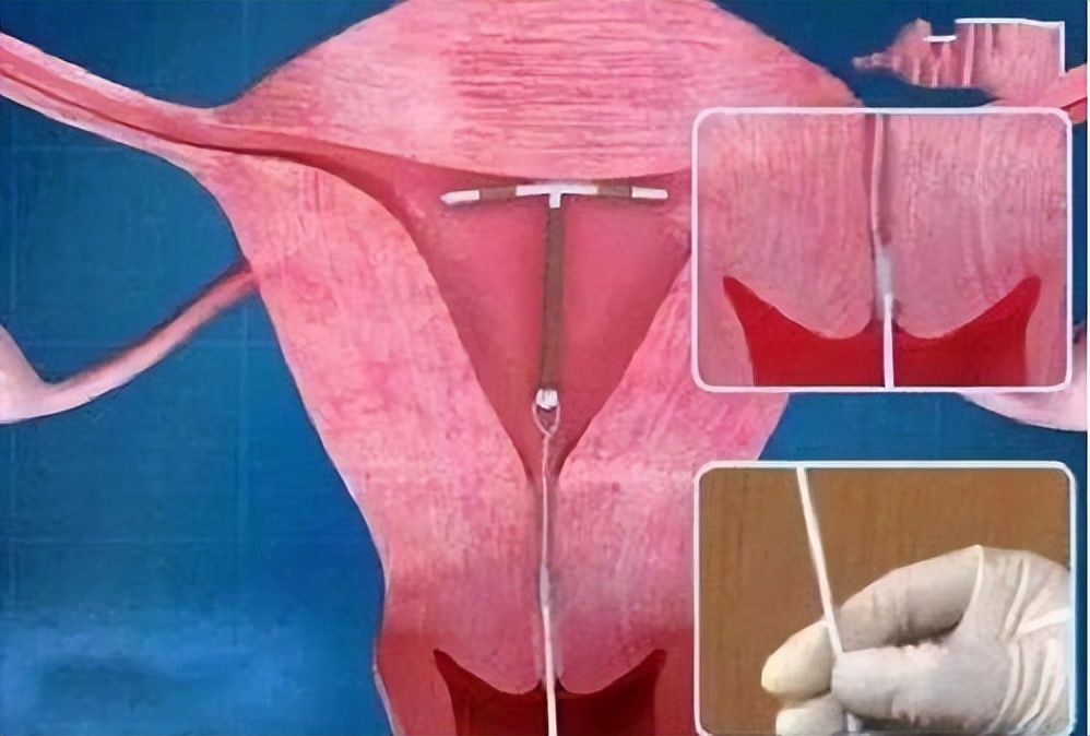 取节育环会有生命危险吗,节育环不取出来会得癌吗