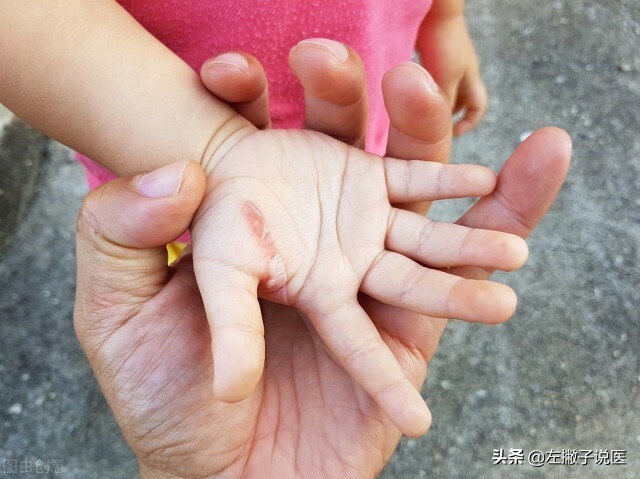 2块钱一支的红霉素软膏3个功效,红霉素软膏真的是皮肤的万能药吗