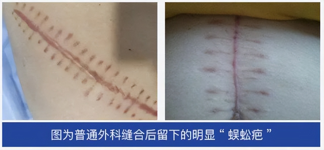 鄂尔多斯市中医医院急诊科,急诊科美容缝合后护理