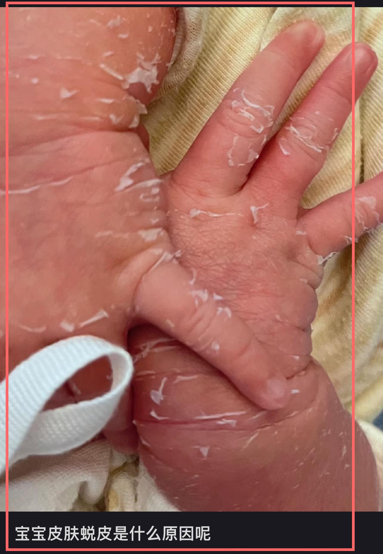 新生儿皮肤脱皮怎么回事？日常护理注意8点，爸妈早知道早放心