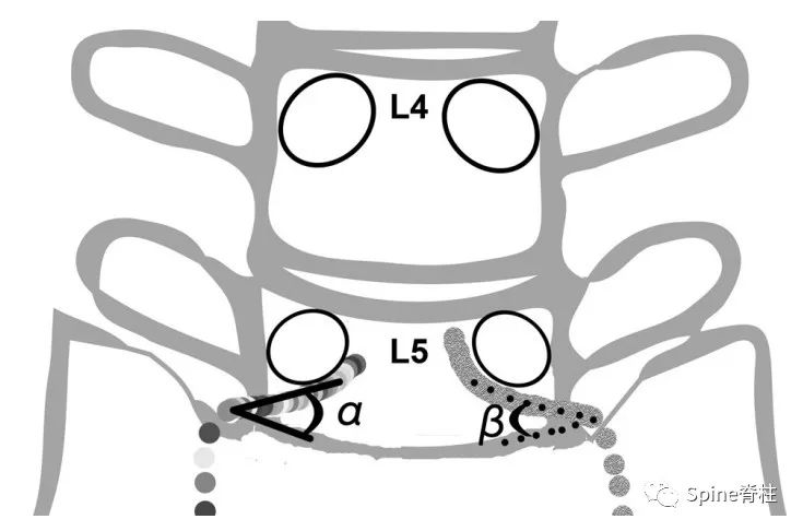 腰椎间盘突出下肢放射痛严重吗,下肢放射疼痛是间断性严重吗