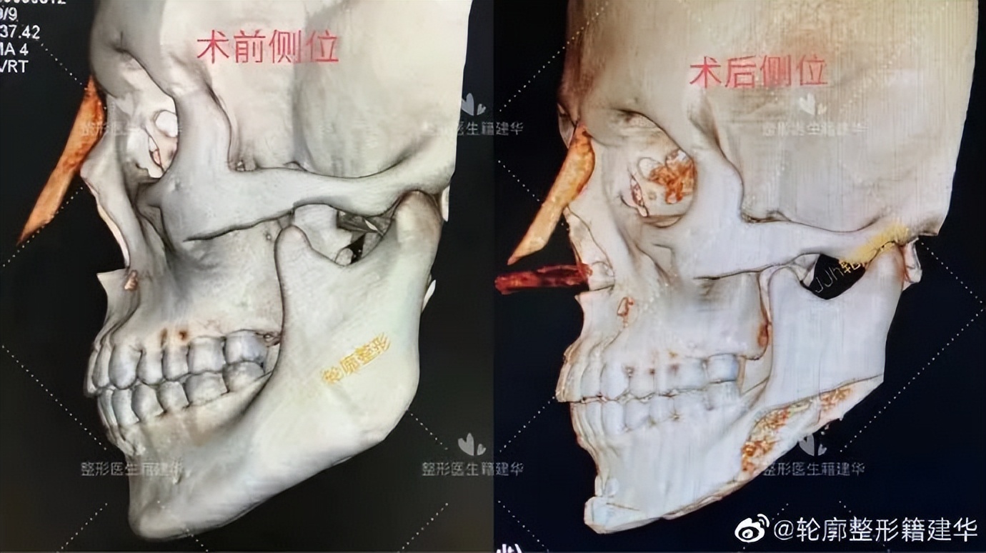 下巴后缩是不是最难看的,下巴后缩明星怎么改善