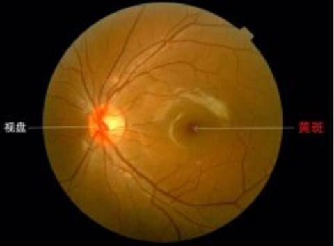眼睛黄斑长了一层膜,小孩眼睛长黄斑怎么回事