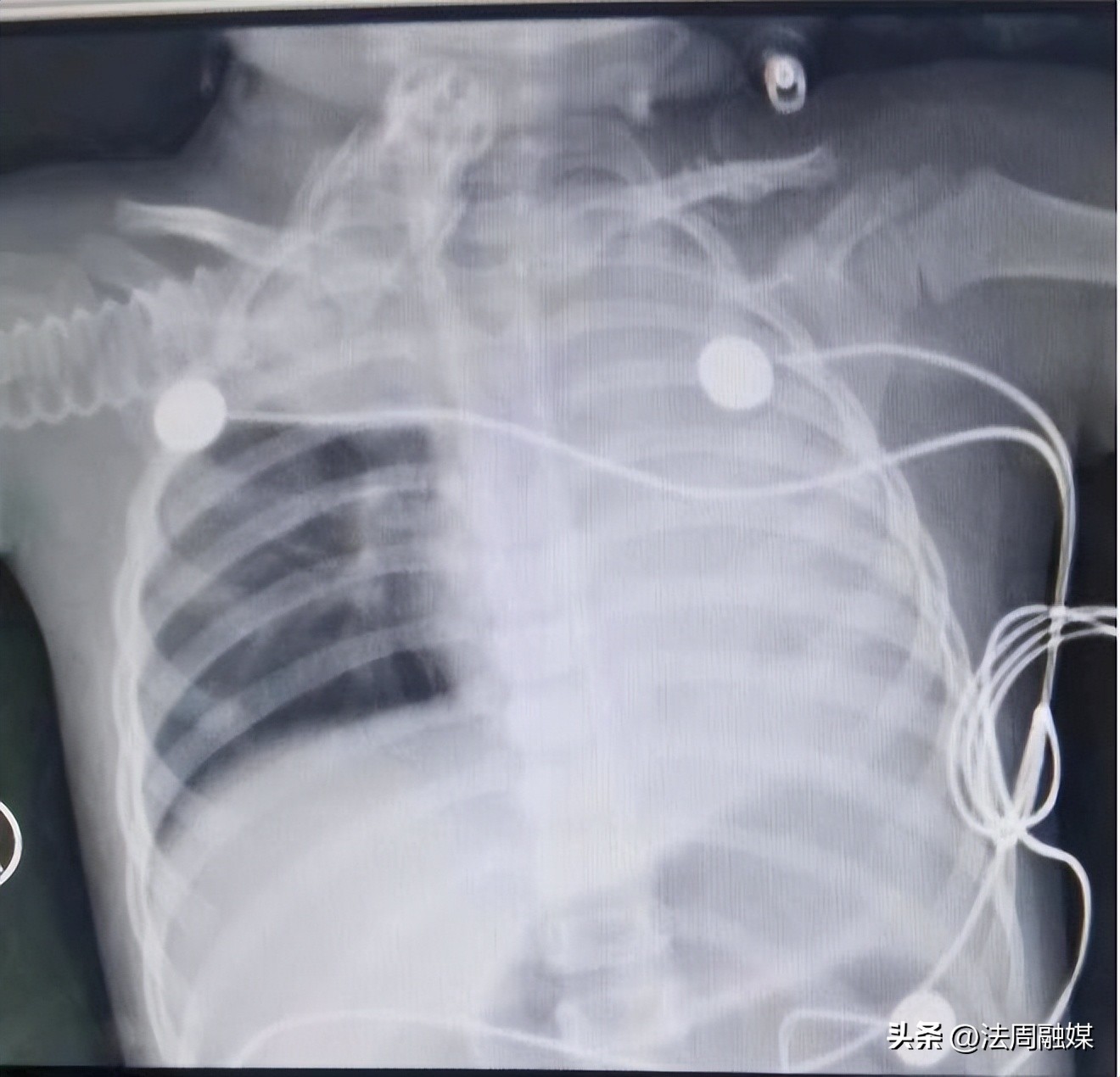 儿童吃花生卡气管死亡,小孩去吃坚果卡住医生接力急救