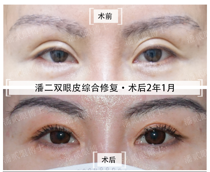 双眼皮修复脂肪填充成活率高吗,全脸脂肪填充跟双眼皮怎么一起做
